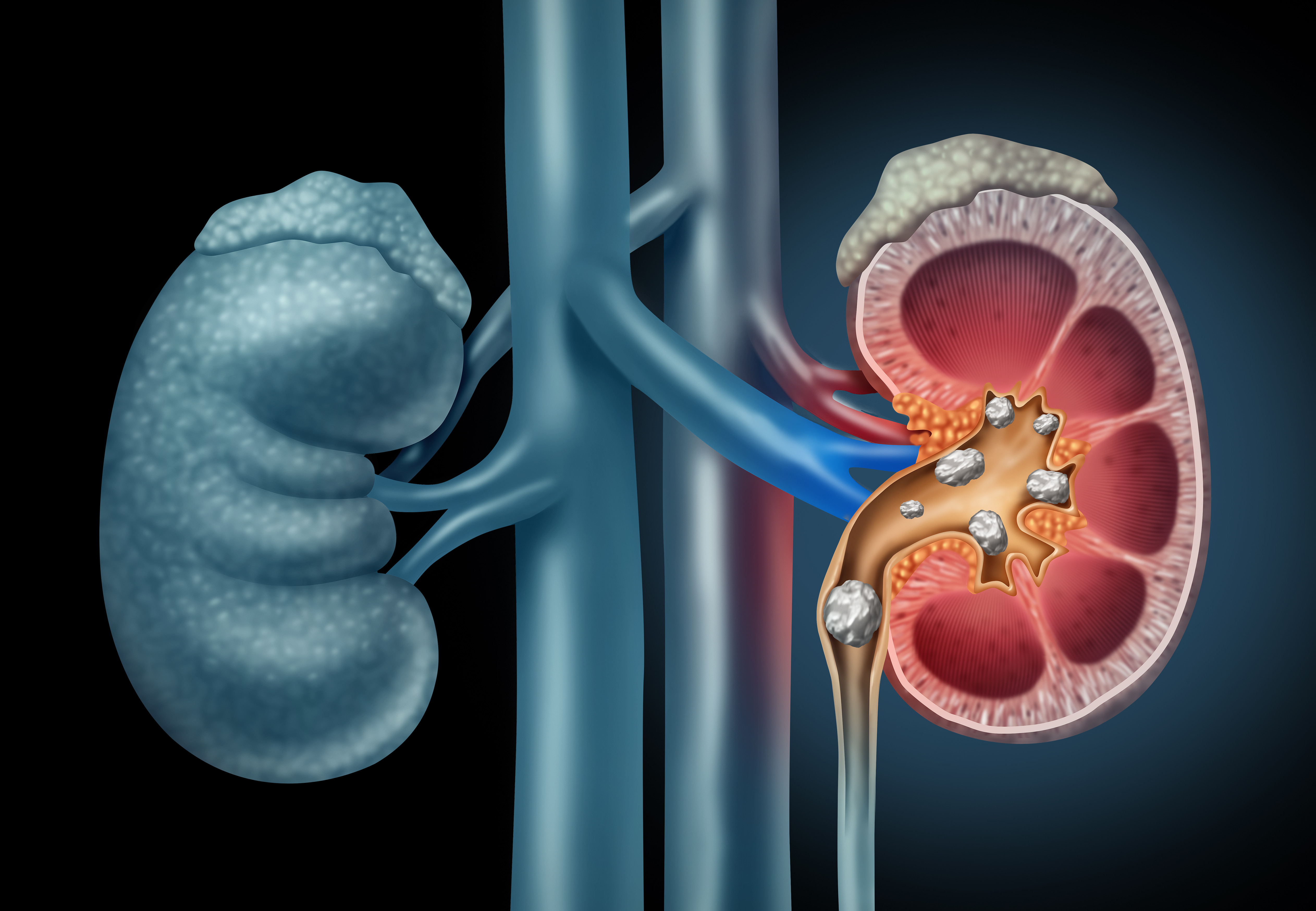 Kidney with kidney stones