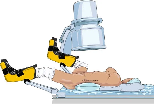 Digital drawing of a supine PCNL surgery